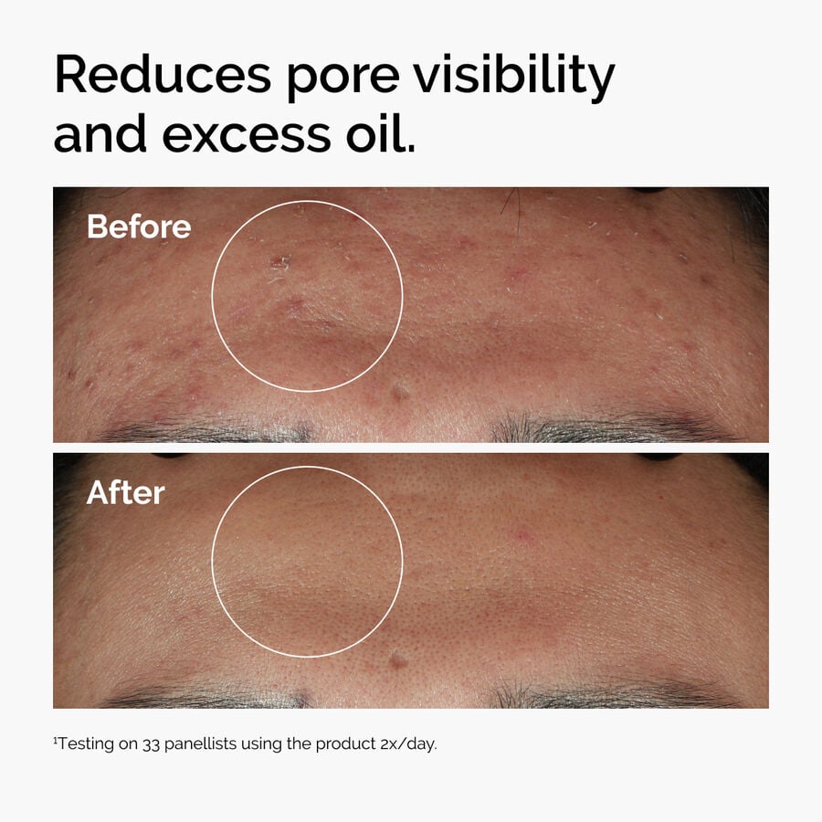 niacinamide-10-zinc-1-z5 ord-niacinamide-zinc-blemish-serum-before-after-pores.jpg