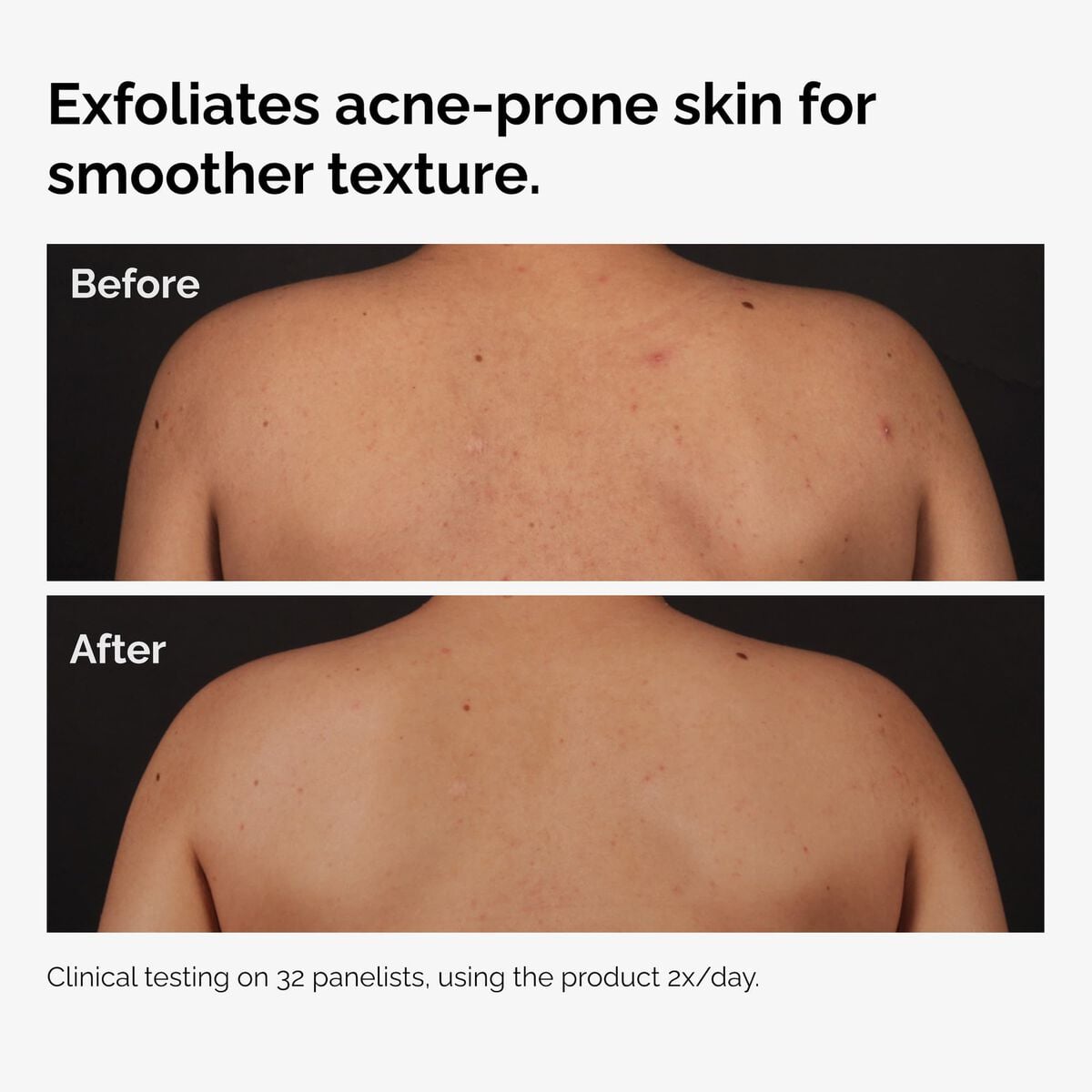 salicylic-acid-0-5-body-serum-m1 ord-salicylic-acid-body-serum-before-after-graphic-NA.jpg